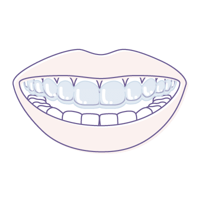 Gouttière Invisalign